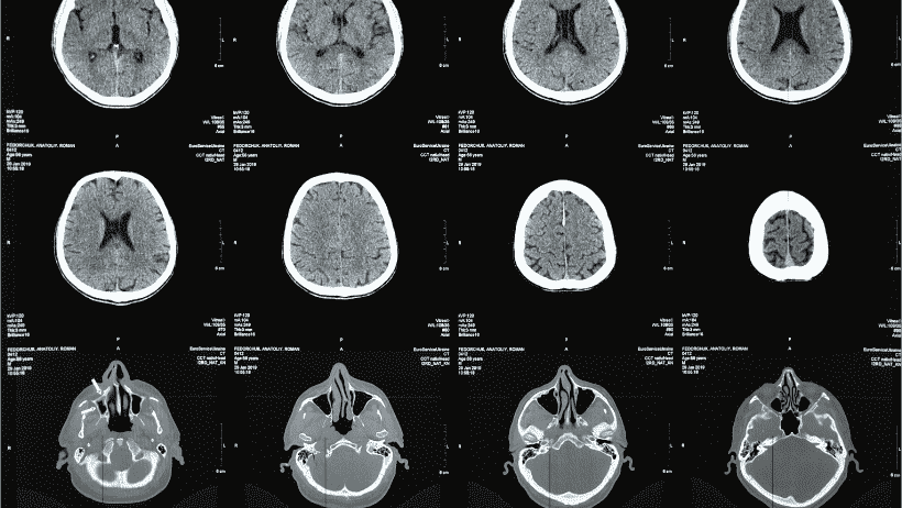 Psilocybin Spurs Growth of Neural Connections Lost in Depression